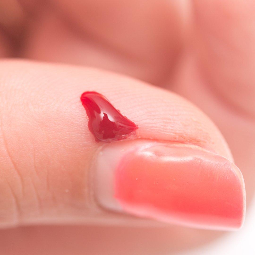 Hemoalustat Flüssigkeit zum Stoppen von Nagelhautblutungen 10 ml Blutstillender Hautschutz