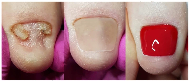 Allepaznokcie Podologisches Nagelrekonstruktionsgel, klare Pediküre, 5 ml